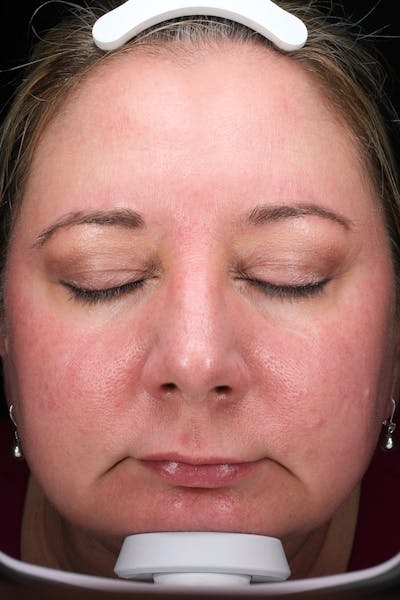 Lasers & Light Before & After Gallery - Patient 117360 - Image 1