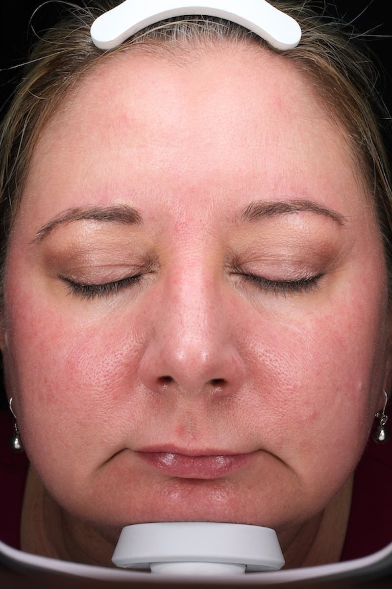 Lasers & Light Before & After Gallery - Patient 117360 - Image 1