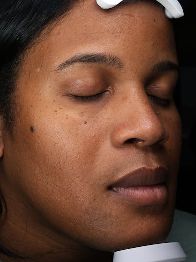 Laser Hair Reduction Before & After Gallery - Patient 123313 - Image 1