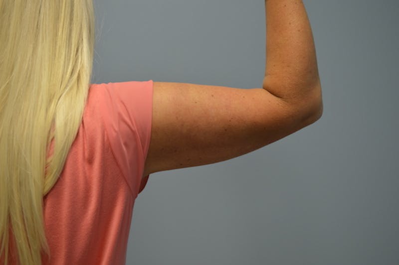 BodyTite (Scarless Skin Tightening) Before & After Gallery - Patient 393544 - Image 4