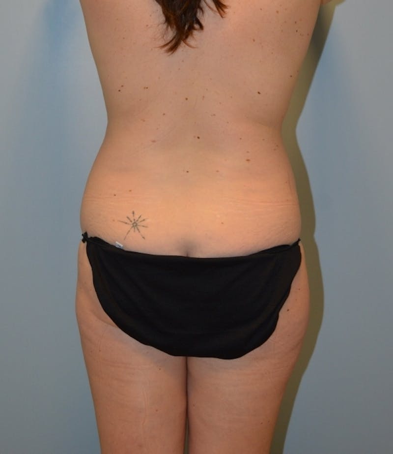 Tummy Tuck Before & After Gallery - Patient 429423 - Image 7