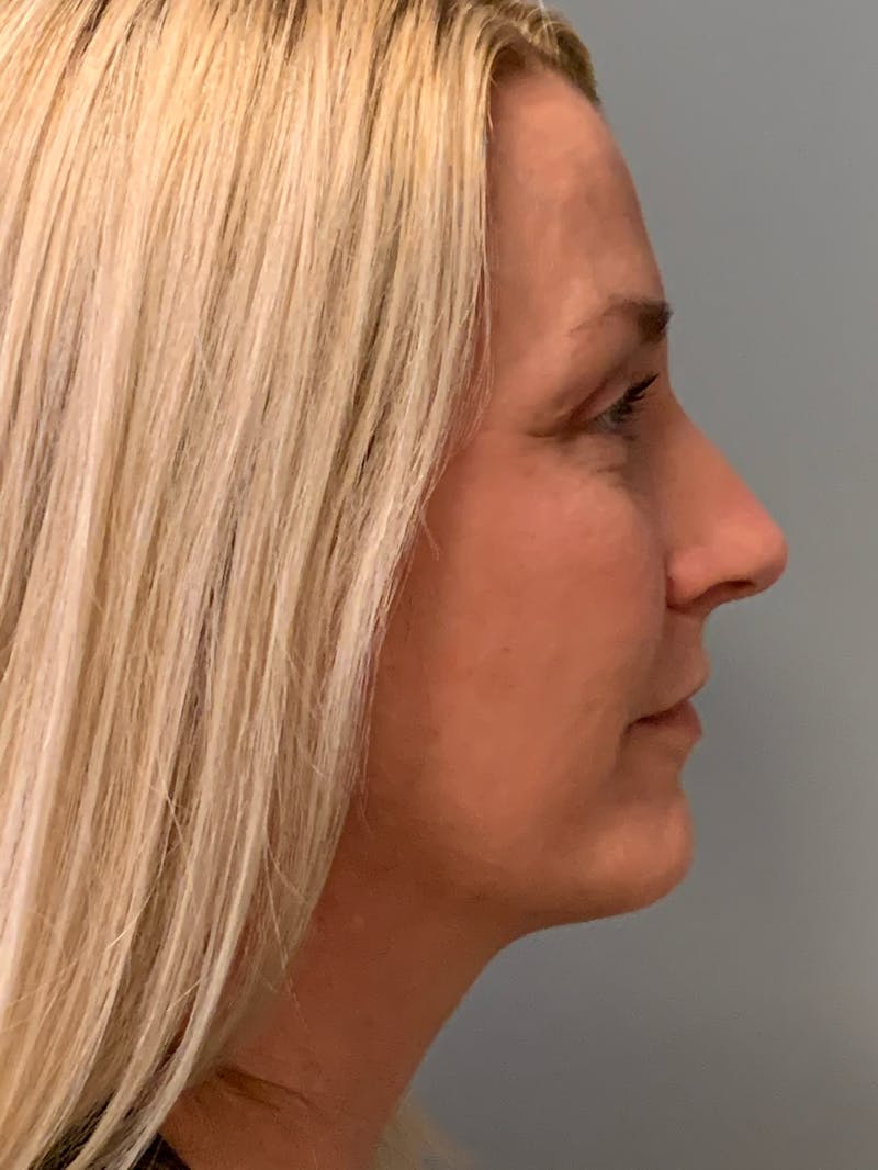 Blepharoplasty Before & After Gallery - Patient 387357 - Image 6