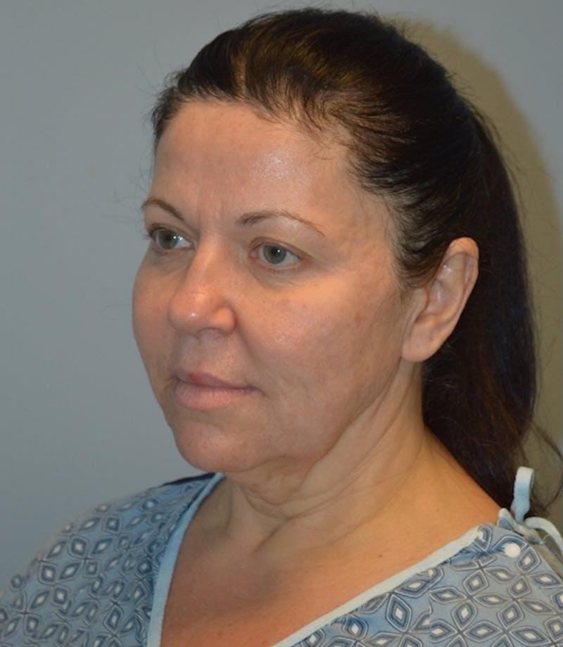 Facelift Before & After Gallery - Patient 254175 - Image 3