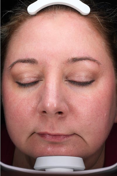 Lasers & Light Before & After Gallery - Patient 117360 - Image 2