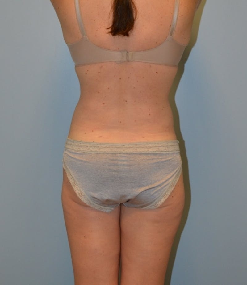Tummy Tuck Before & After Gallery - Patient 429423 - Image 8
