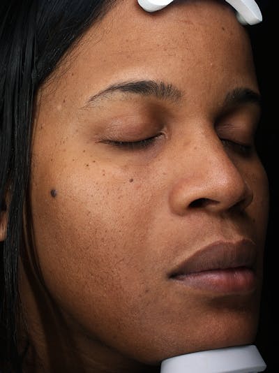 Laser Hair Reduction Before & After Gallery - Patient 123313 - Image 2