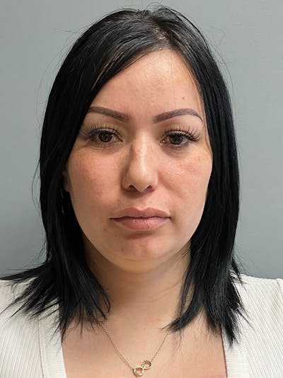 Deep Plane Neck Lift Before & After Gallery - Patient 158517 - Image 1