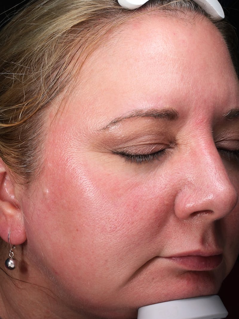 Lasers & Light Before & After Gallery - Patient 117360 - Image 3