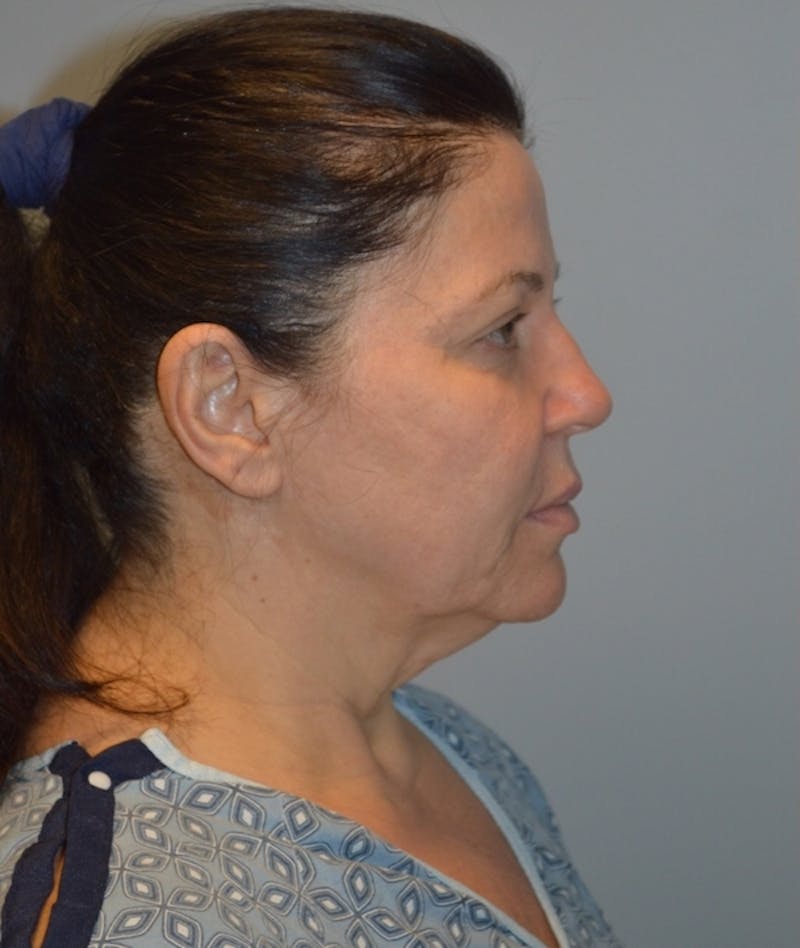 Facelift Before & After Gallery - Patient 254175 - Image 5