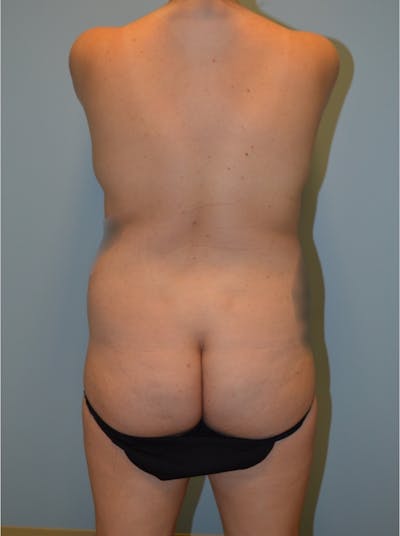 Tummy Tuck Before & After Gallery - Patient 274096 - Image 1