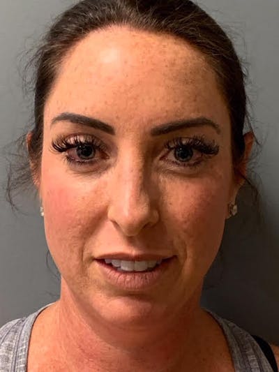 Neck Lift Before & After Gallery - Patient 238331 - Image 1