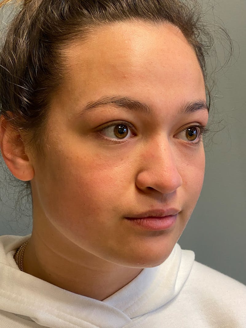 Rhinoplasty Before & After Gallery - Patient 278504 - Image 3