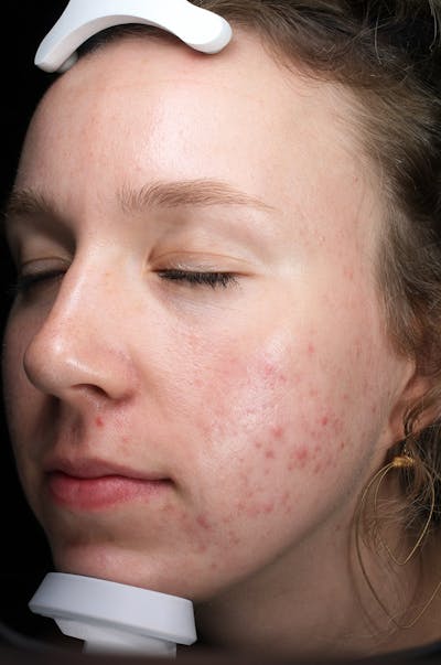Microneedling Before & After Gallery - Patient 417389 - Image 1
