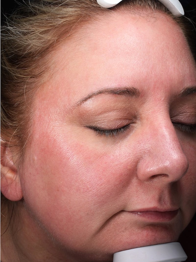 Lasers & Light Before & After Gallery - Patient 117360 - Image 4