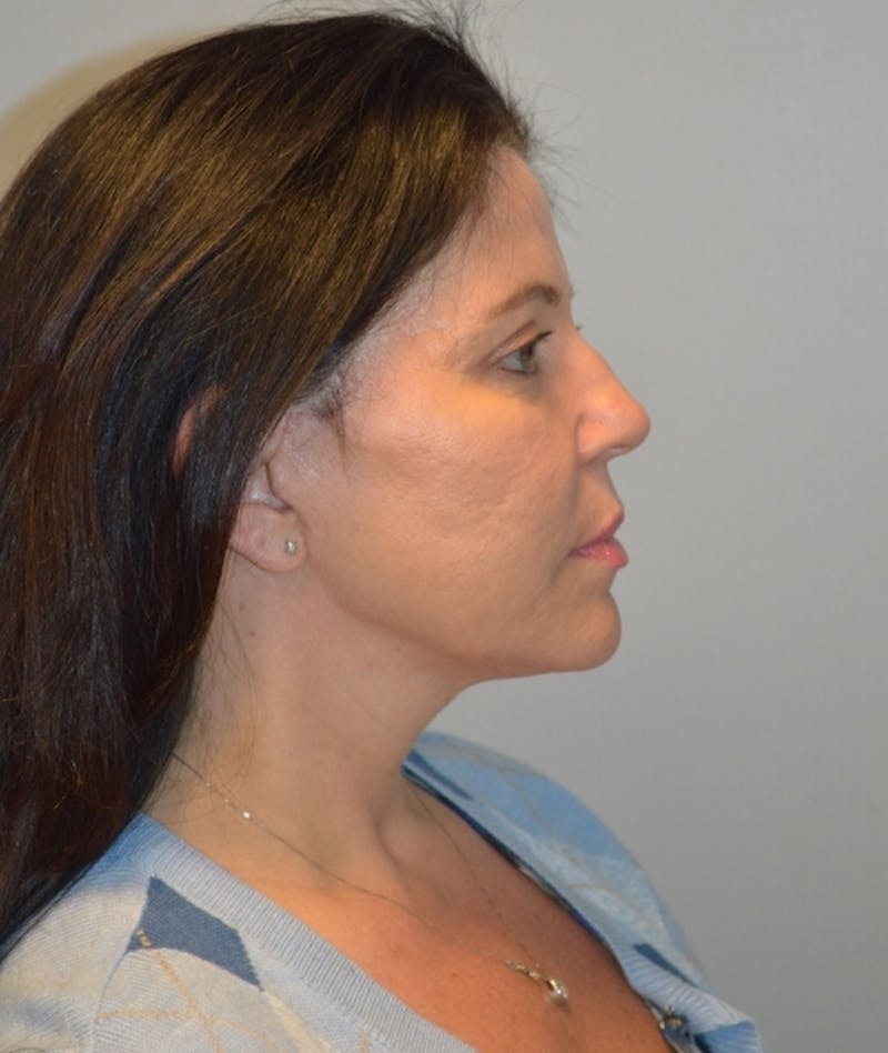 Facelift Before & After Gallery - Patient 254175 - Image 6