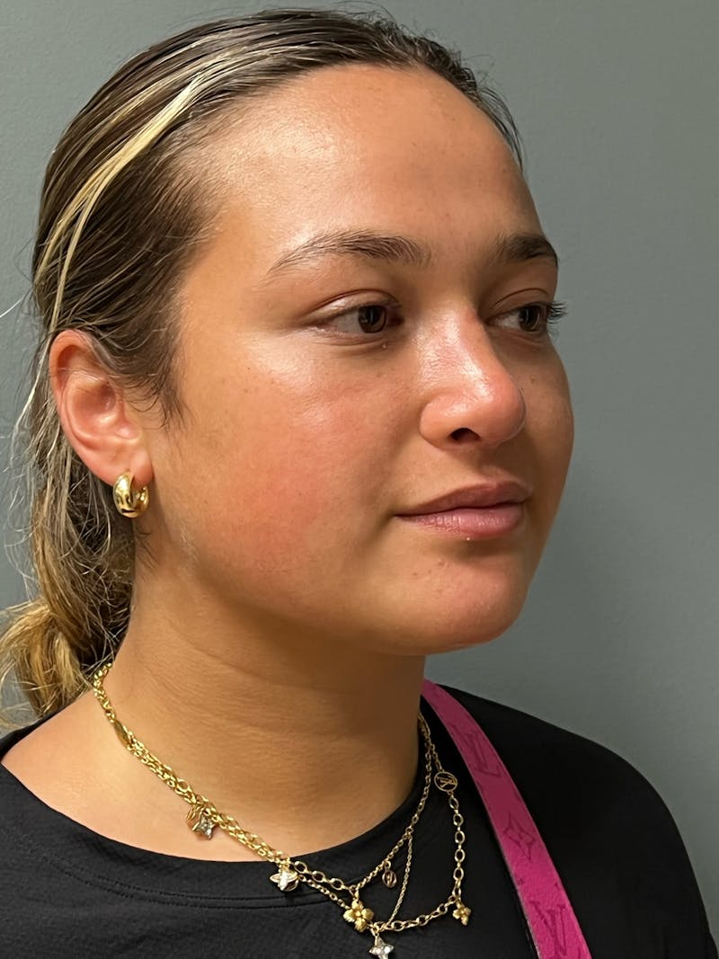 Rhinoplasty Before & After Gallery - Patient 278504 - Image 4