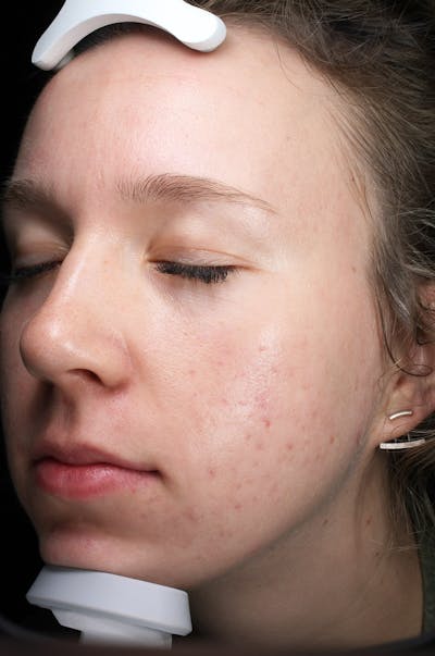 Microneedling Before & After Gallery - Patient 417389 - Image 2
