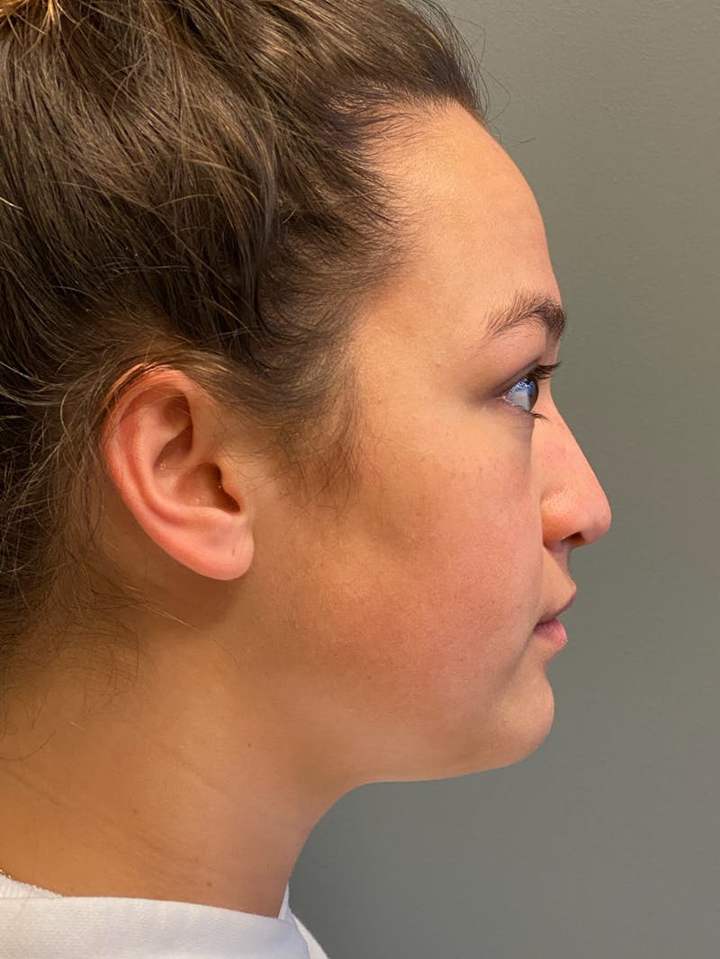Rhinoplasty Before & After Gallery - Patient 278504 - Image 5