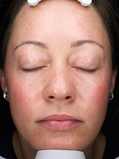 Lasers & Light Before & After Gallery - Patient 298657 - Image 1