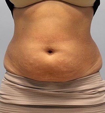 Fat Reduction (Non-Invasive) Before & After Gallery - Patient 202917 - Image 1