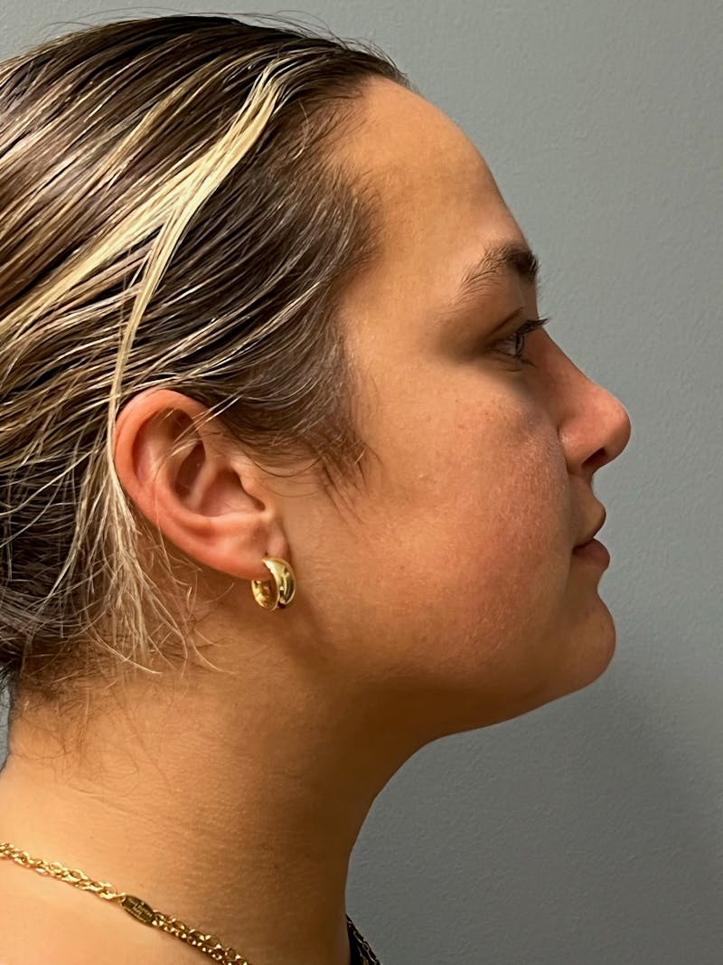 Rhinoplasty Before & After Gallery - Patient 278504 - Image 6