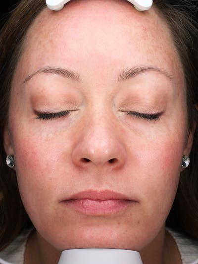 Lasers & Light Before & After Gallery - Patient 298657 - Image 2