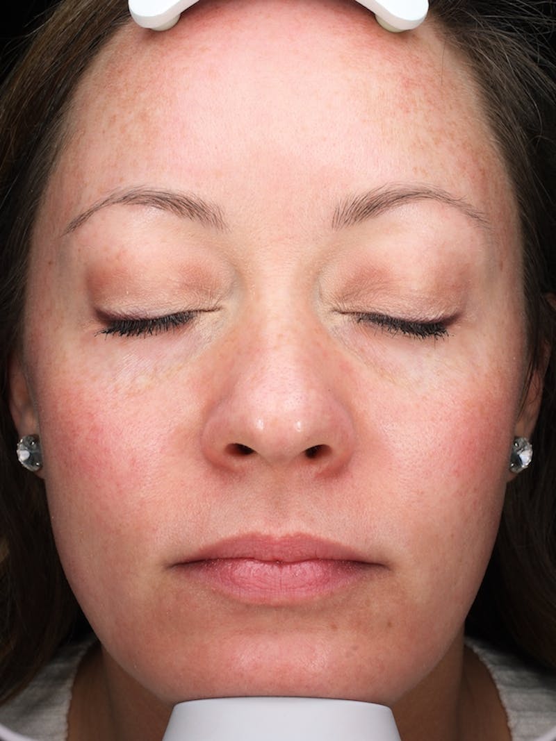 Lasers & Light Before & After Gallery - Patient 298657 - Image 2