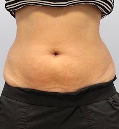 Fat Reduction (Non-Invasive) Before & After Gallery - Patient 202917 - Image 2