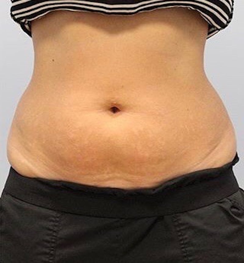 Fat Reduction (Non-Invasive) Before & After Gallery - Patient 202917 - Image 2