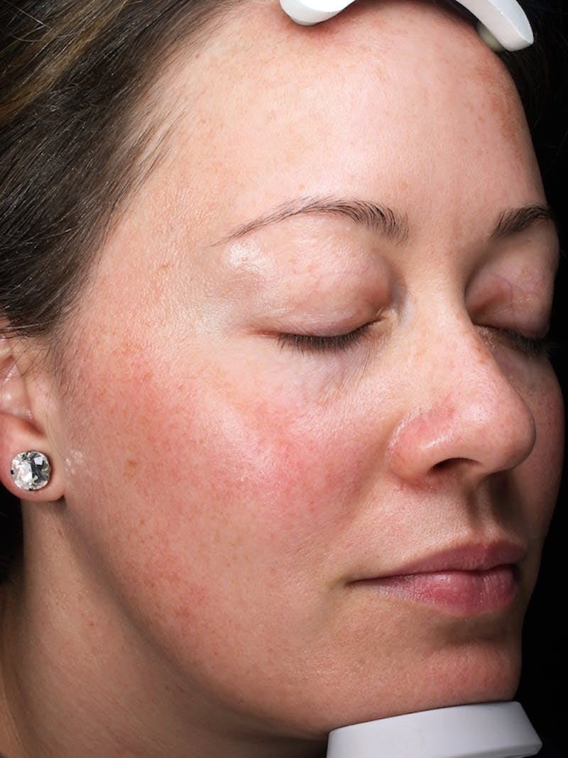 Lasers & Light Before & After Gallery - Patient 298657 - Image 3