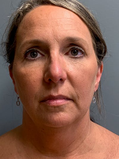 Deep Plane Neck Lift Before & After Gallery - Patient 177363 - Image 1