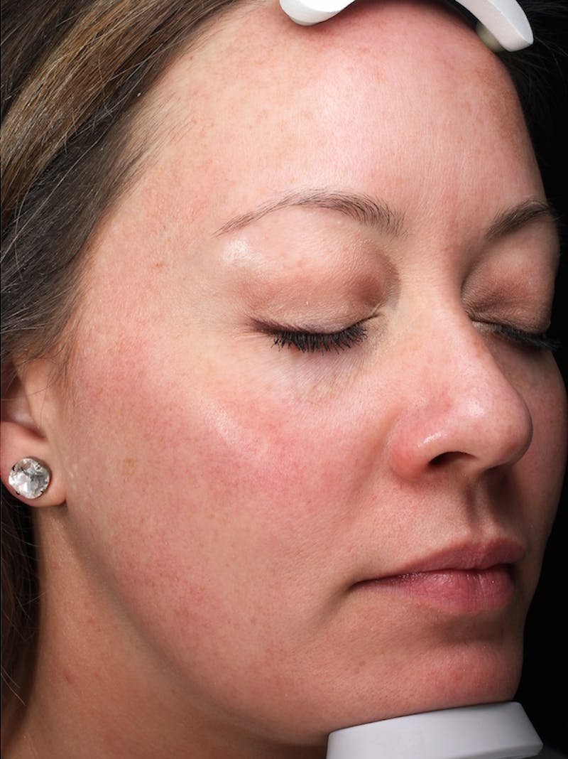Lasers & Light Before & After Gallery - Patient 298657 - Image 4