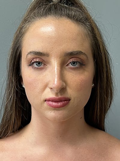 Rhinoplasty Before & After Gallery - Patient 415315 - Image 1