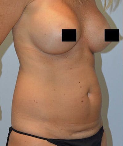 High Definition Mommy Makeover Before & After Gallery - Patient 280543 - Image 1