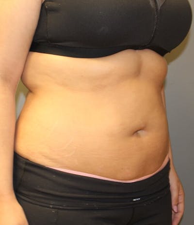 Fat Reduction (Non-Invasive) Before & After Gallery - Patient 263359 - Image 1