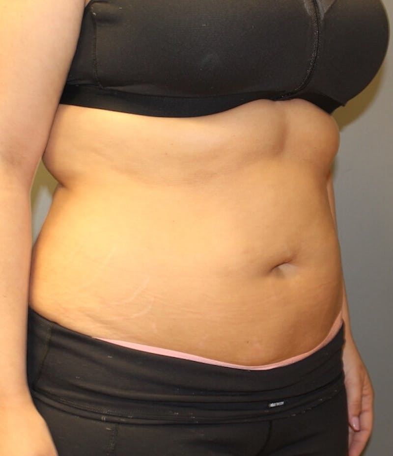 Fat Reduction (Non-Invasive) Before & After Gallery - Patient 263359 - Image 1