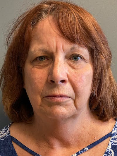 Deep Plane Facelift Before & After Gallery - Patient 273208 - Image 1