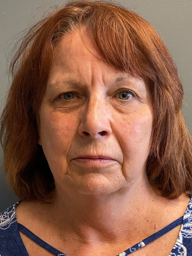 Deep Plane Facelift Before & After Gallery - Patient 273208 - Image 1