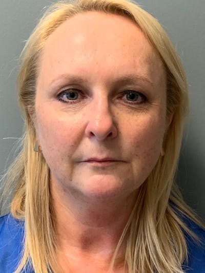 Neck Lift Before & After Gallery - Patient 400446 - Image 1
