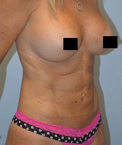 High Definition Mommy Makeover Before & After Gallery - Patient 280543 - Image 2