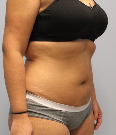Fat Reduction (Non-Invasive) Before & After Gallery - Patient 263359 - Image 2