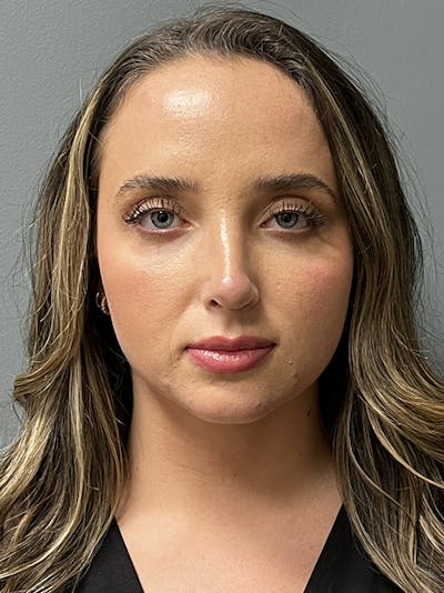 Rhinoplasty Before & After Gallery - Patient 415315 - Image 2