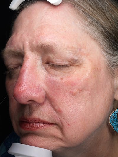 Lasers & Light Before & After Gallery - Patient 421204 - Image 1