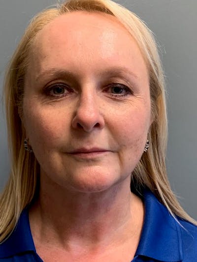 Neck Lift Before & After Gallery - Patient 400446 - Image 2