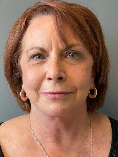 Deep Plane Facelift Before & After Gallery - Patient 273208 - Image 2
