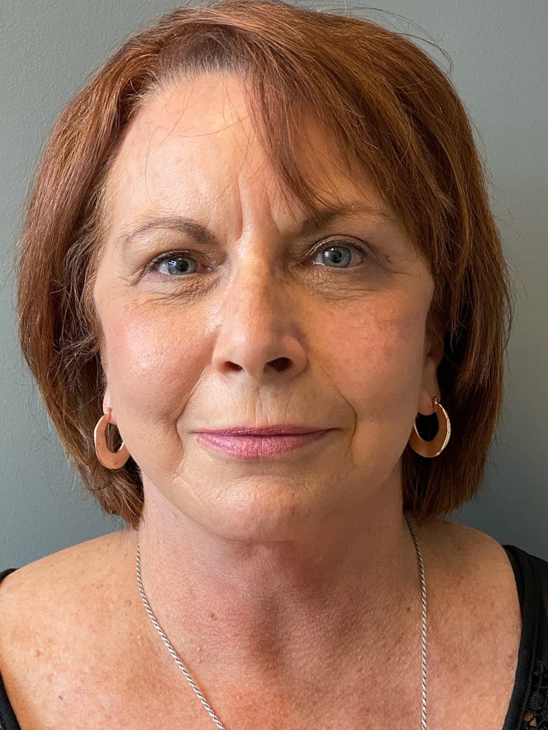 Deep Plane Facelift Before & After Gallery - Patient 273208 - Image 2