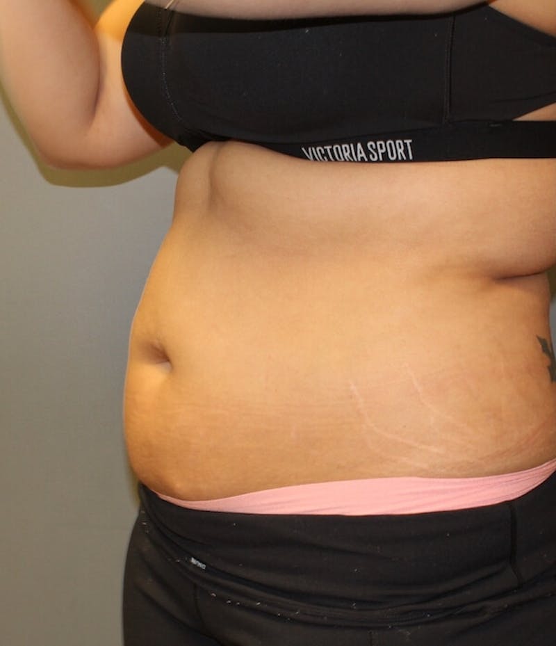 Fat Reduction (Non-Invasive) Before & After Gallery - Patient 263359 - Image 3
