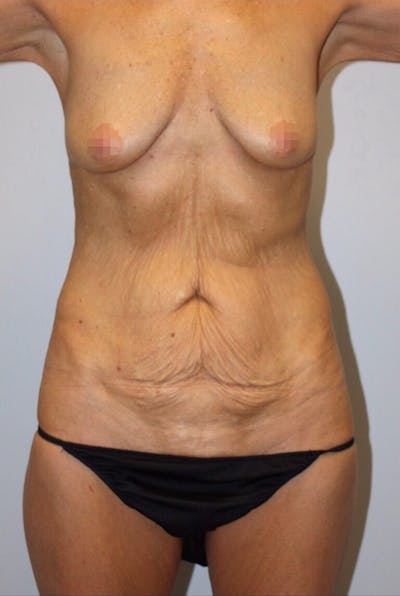 High Definition Mommy Makeover Before & After Gallery - Patient 253915 - Image 1