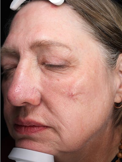 Lasers & Light Before & After Gallery - Patient 421204 - Image 2