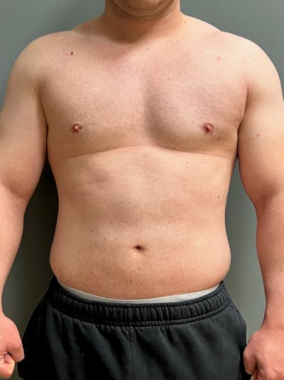 Hi Def Liposuction Before & After Gallery - Patient 288494 - Image 1